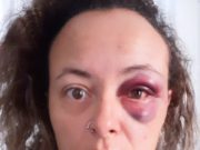 VÍTIMA DE VIOLÊNCIA DOMÉSTICA PRECISA DE CIRURGIA; SAIBA COMO AJUDAR